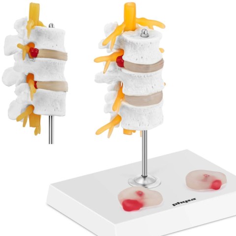 Model anatomiczny 3D odcinka lędźwiowego kręgosłupa z przepukliną kręgi 3-5 Model anatomiczny 3D odcinka lędźwiowego kręgosłupa z przepukliną kręgi 3-5